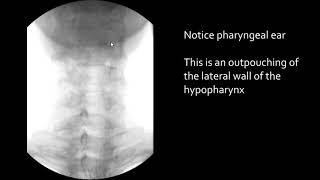 Swallowing Pharyngeal ear