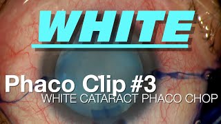 Phaco Clip #3 - White Cataract Phaco Chop