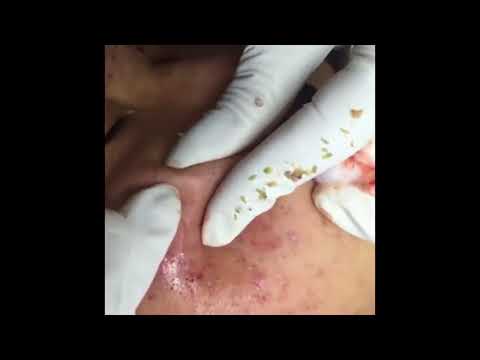Blackhead Removal -  Min of acne extraction - 