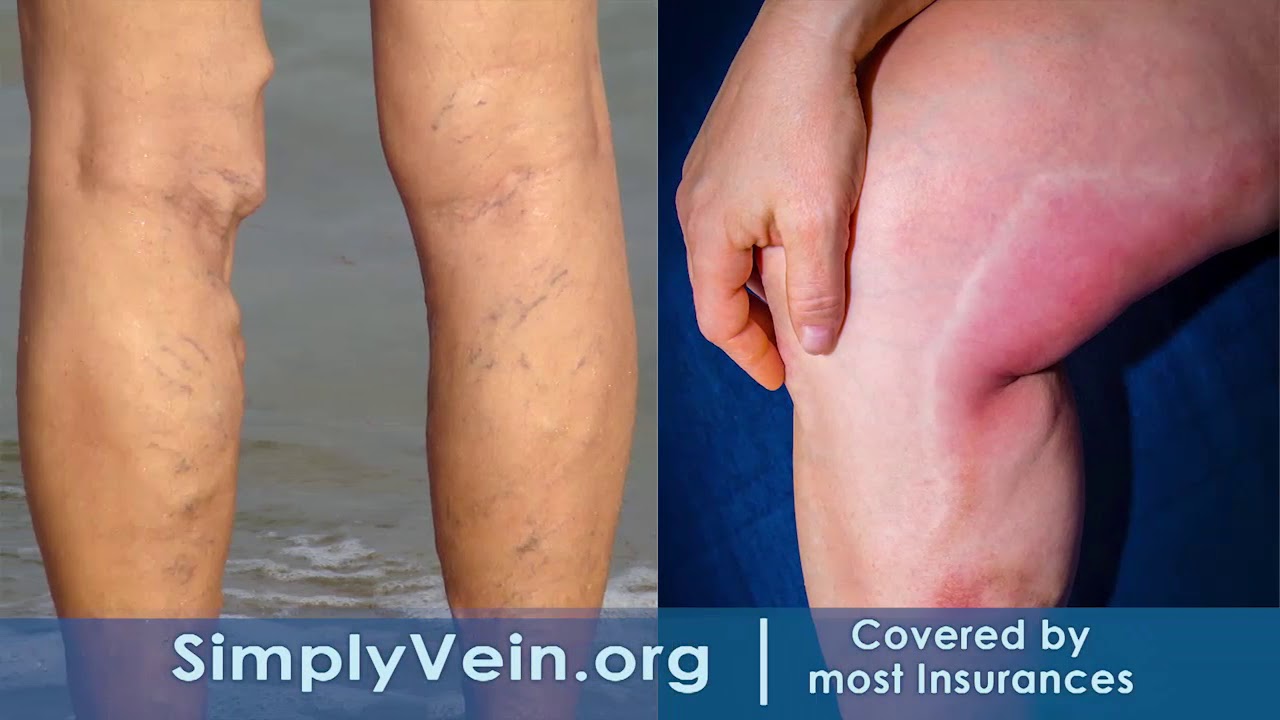 Simply Vein Provides Minimally Invasive Treatment For Varicose Veins