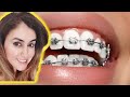 Hacks For Whiter Teeth With Braces!