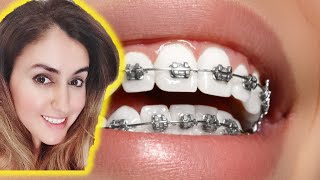 Hacks For Whiter Teeth With Braces