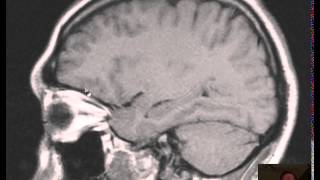 MRI Brain Abscess + Anatomy DISCUSSION