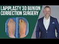 Lapiplasty® Bunion Surgery Explained | Fix Bunions Permanently (3D Correction)