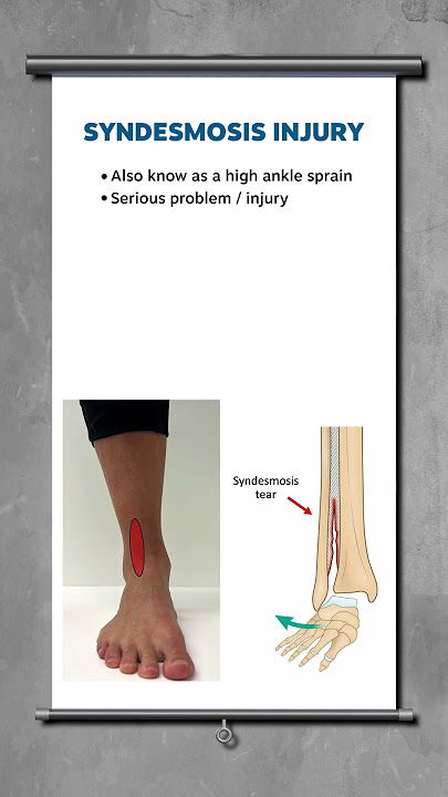 Syndesmosis injury explained