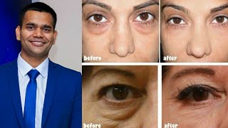 Under Eye Home Remedy | Remove Under Eye Bags Completely | Remove Dark Circle, Wrinkles, Puffy Eyes screenshot 1