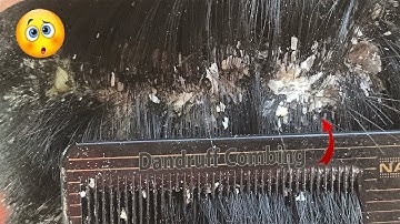 Big flakes || Dandruff Scratching Scalp || Itchy Dry Scalp Treatment #492