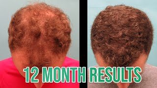 Hair Transplant Results - 12-Month FUT Surgery Follow-up Before and After