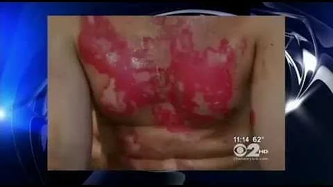 The Dangers of Spray on Sunscreen - New York CBS L...