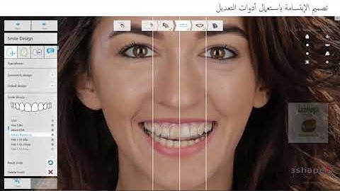 Digitized 3Shape Smile Design 2021 Workflow