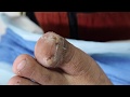 EP_1208 Big ingrown toenail removal 👣 โห..เหมือนงมเข็มในทะเล  (This clip from Thailand)