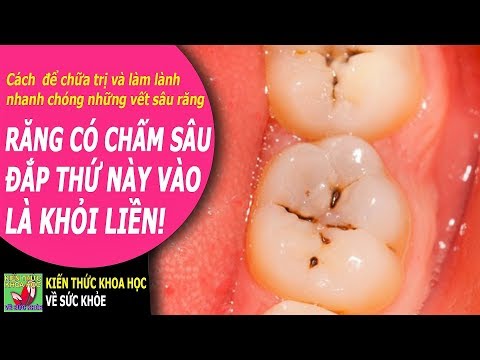 cách vệ sinh răng tại Kemtrinam.vn