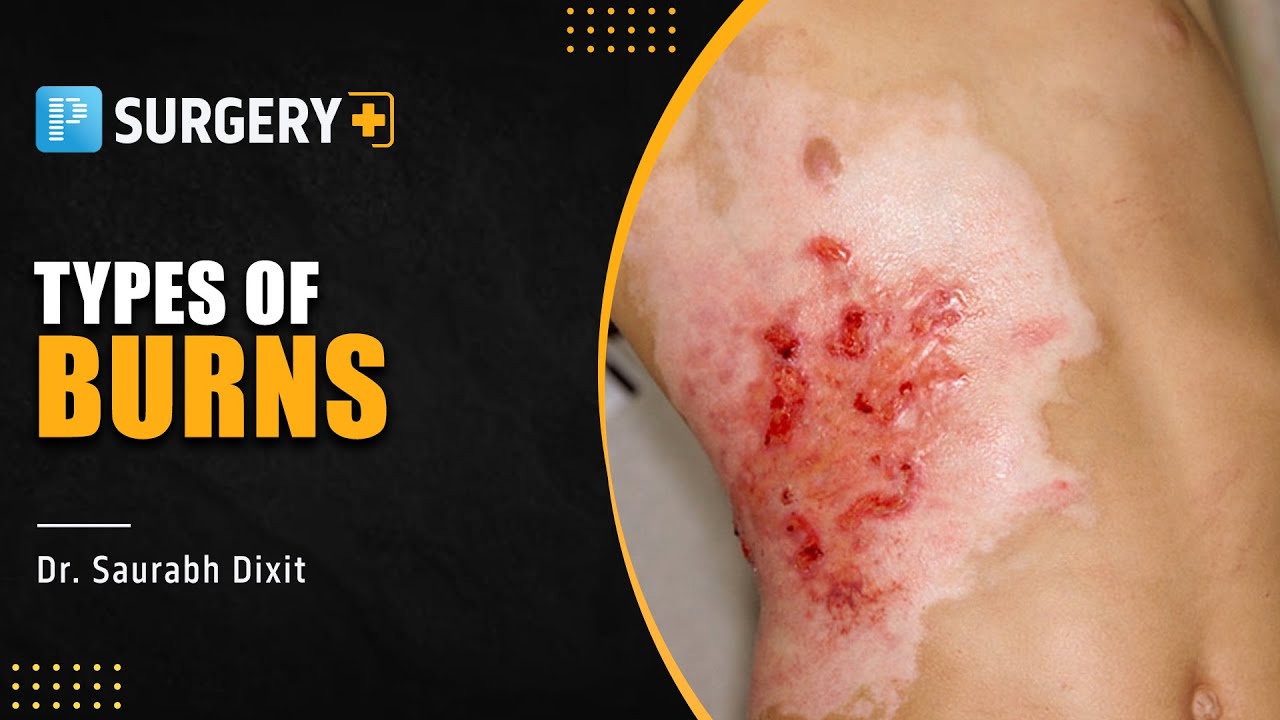 Types of "BURNS" Surgery by Dr. Saurabh Dixit PrepLadder NEETSS