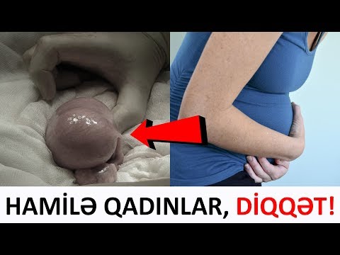 Hamilə qadınlar! Miomalar doğuşa BU CÜR təsir edir