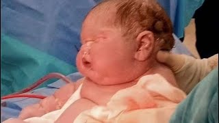 A Woman Gives Birth To A Baby By C-Section;Doctors Left In Shock After Seeing The Newborn