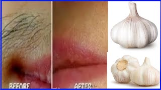 Unwanted hair removal for women naturally with garlic remedy / face hair removal for women at home