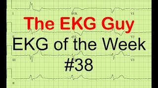 EKG/ECG of the Week #38 | The EKG Guy - www.ekg.md News