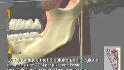 Presentation of CMTH (three-dimensional mandibular concept of Dr. Harb) by 3D animation
