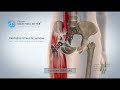 Prothse totale de hanche par voie antrieure miniinvasive  dr matthieu meyer