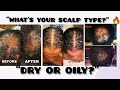 “WHAT’S YOUR SCALP TYPE?” 🔥“DRY OR OILY?”