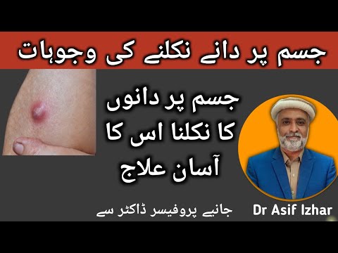 Skin Boils Treatment | Abscess Treatment | Phansi Phoro Ka Ilaj | Jism Par Bar Bar Dano Ka Nikalna