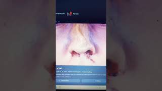 Bearst Fractured Nose Jesse And Mike 2028