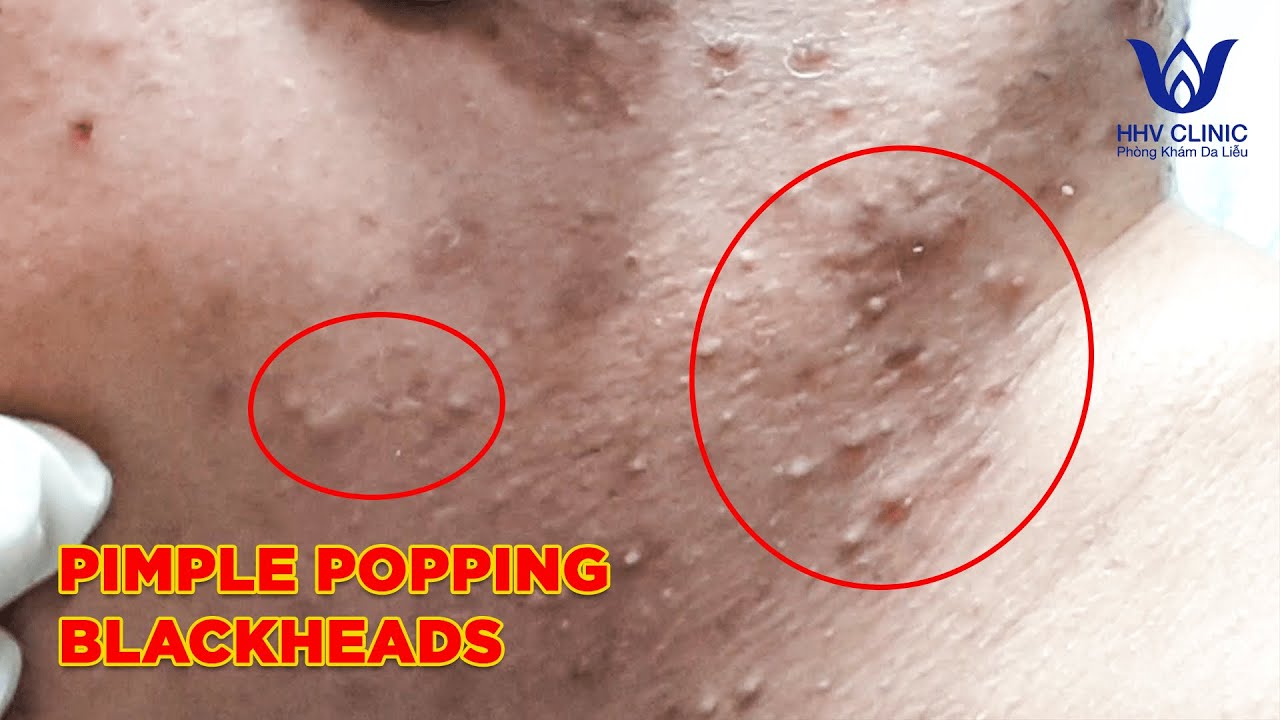 HHV Clinic | dothuhien | Pimple popping blackheads - Vo Duy Thuan - Part 1