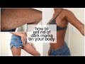 HOW TO GET RID OF DARK MARKS ON YOUR BODY