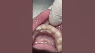 Extraction of deciduous teeth #dentist