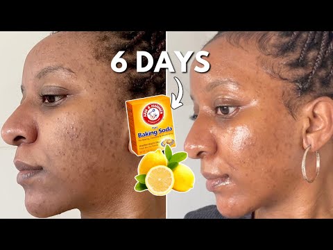 Mix Baking Soda and Lemon Juice 6 DAYS CLEAR SKIN HACK