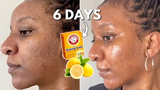 Mix Baking Soda and Lemon Juice 6 DAYS CLEAR SKIN HACK
