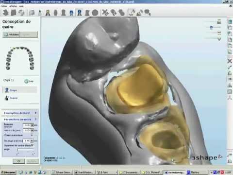 cad cam dental inlay core - YouTube