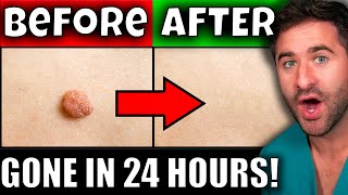 Get Rid of Skin Tags & Warts in 24 Hours
