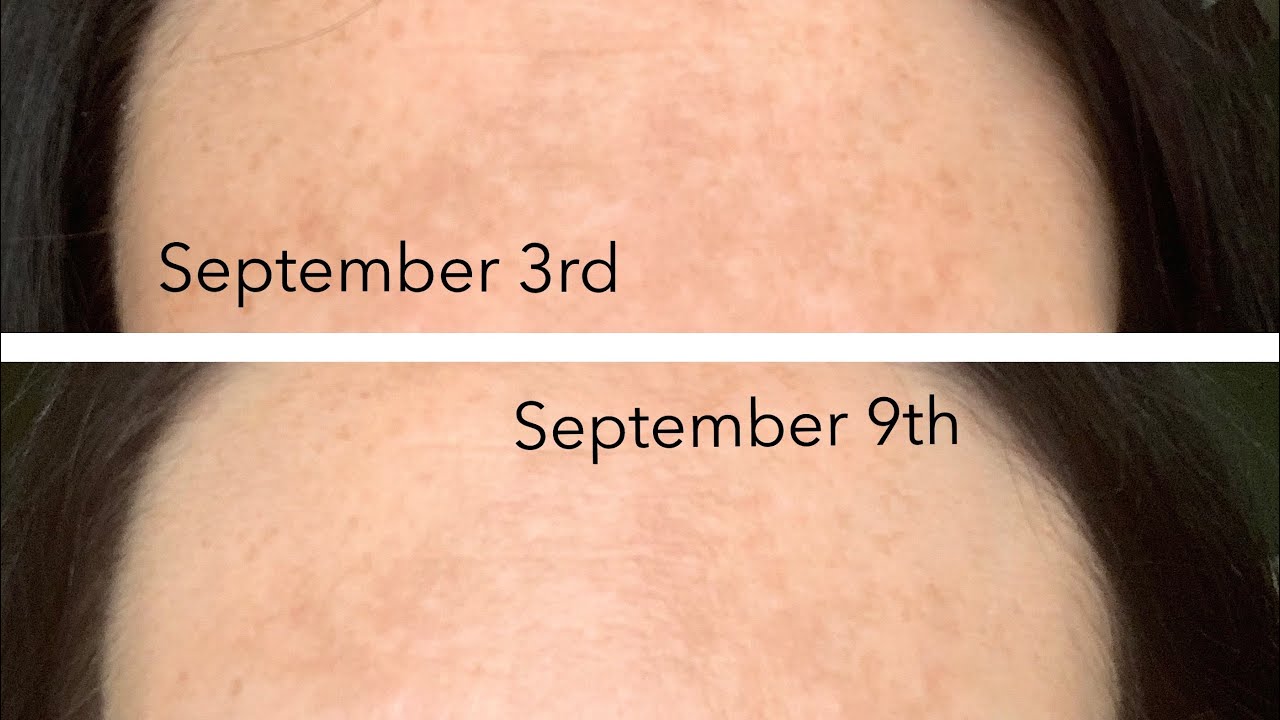 Musely Melasma experiment YouTube