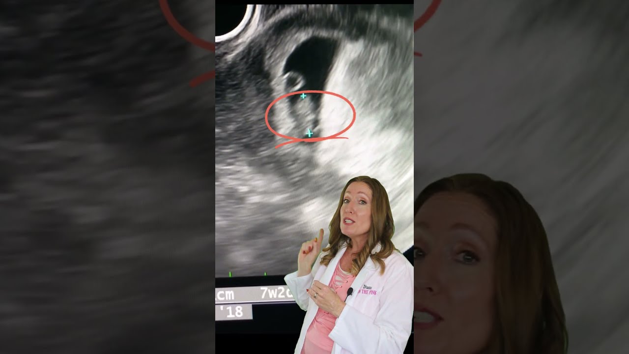 Can You HEAR The Heartbeat On A 7 Week Ultrasound 