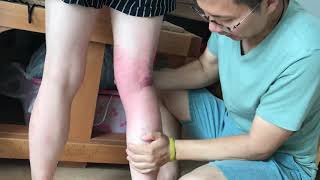 無法盤腿及膝蓋積水處理?(3) 赤腳先20180725 12:38