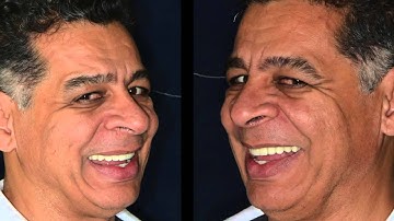 Caso Finalizado - Implante Zigomático