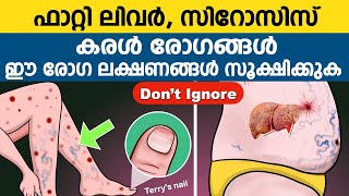 ഫാറ്റി ലിവർ സിറോസിസ് കരൾ രോഗങ്ങൾ മാറാൻ | Fatty Liver, Cirrhosis - Liver Disease Reversal