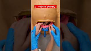 Cesarean Section Delivery C Section Delivery