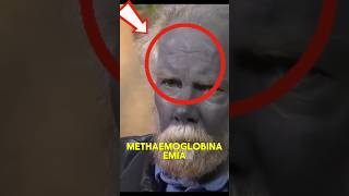 THIS Strange Condition Changes Skin Color 😨 #facts
