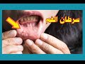 سرطان الفم 
