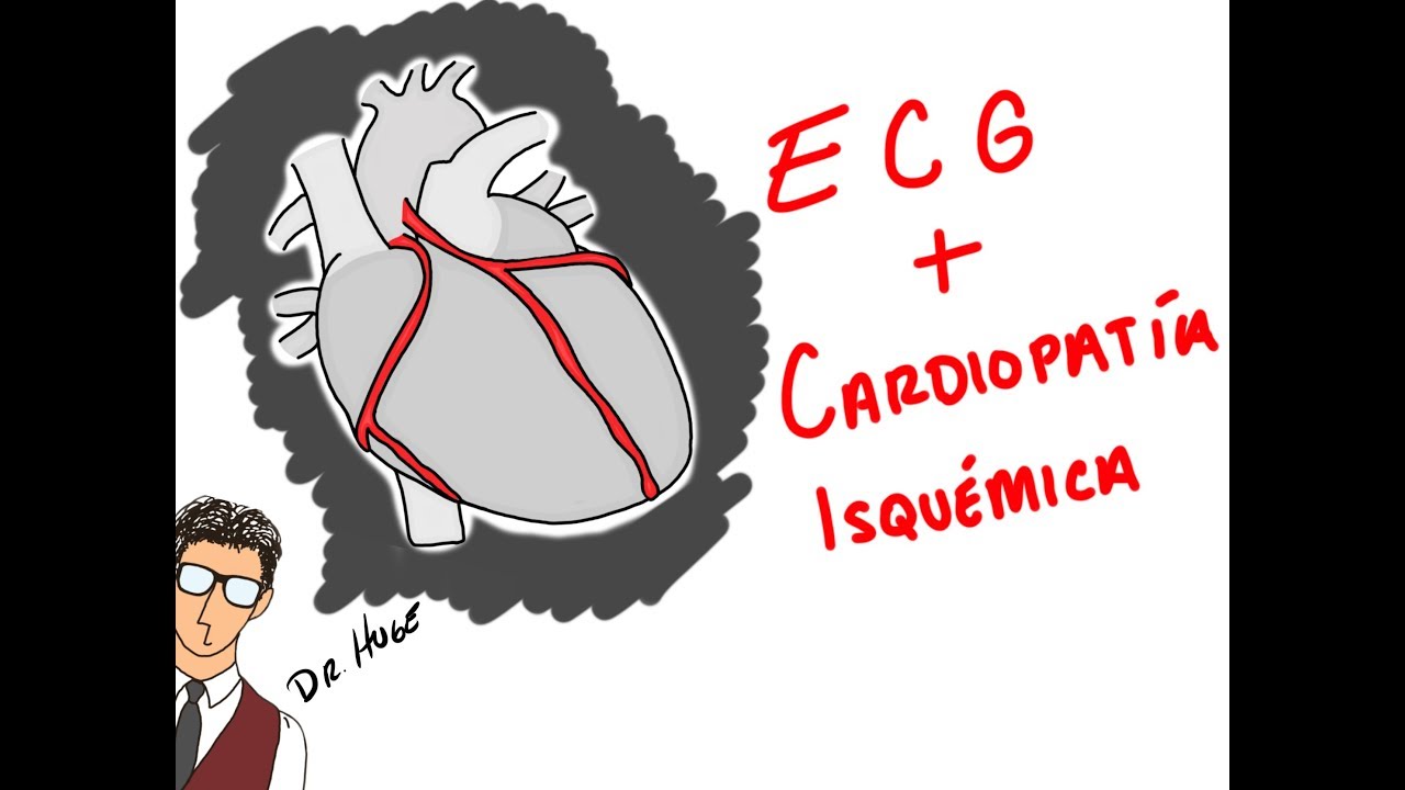 INFARTOS Y ECG COMO NADIE TE LO HA EXPLICADO