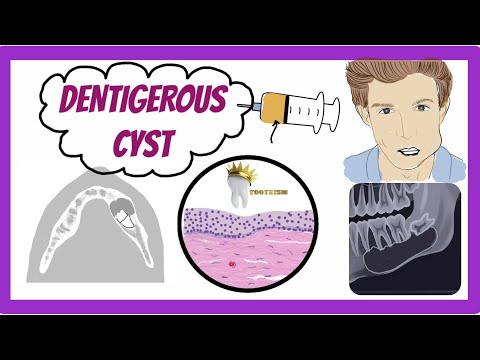 Video: Hoeveel soorten dentigerous cysten zijn er?