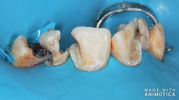 Rubber dam isolation tip (Teflon retraction)