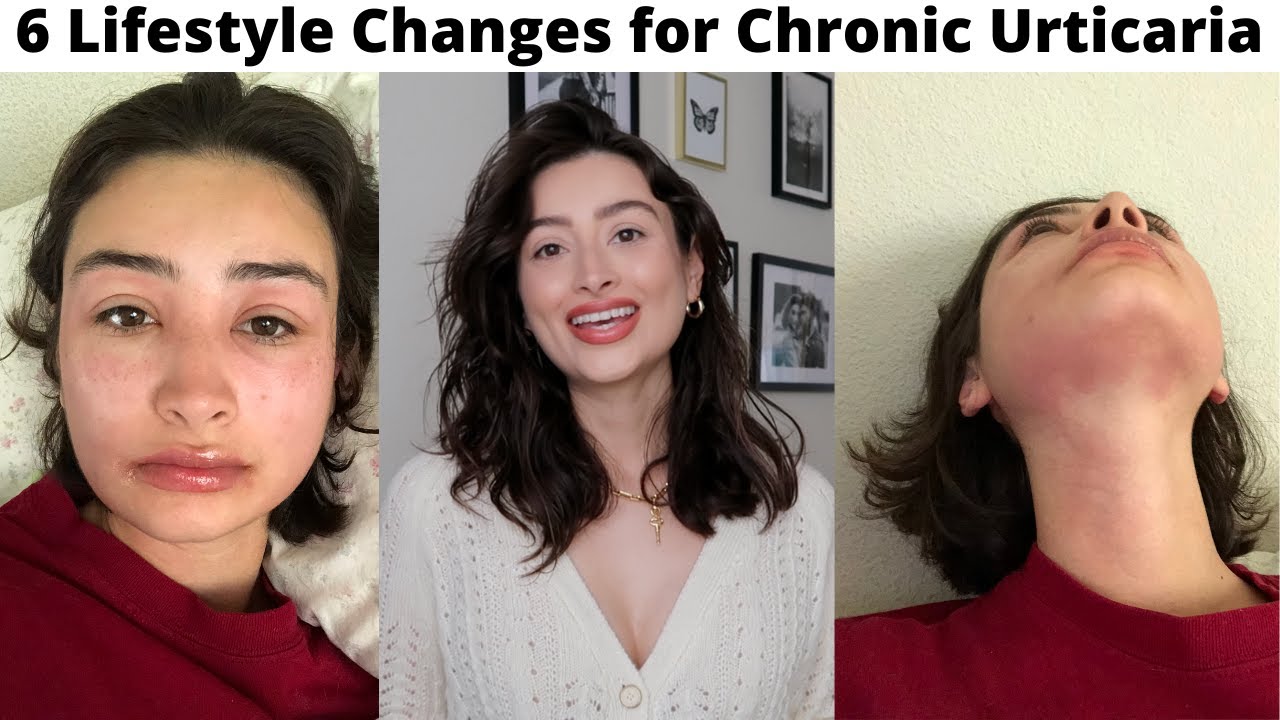 6 Lifestyle Changes Ive Made Since Developing Chronic Urticaria How