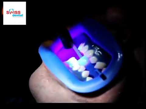 Video: A funksionon zbardhja e dhëmbëve me opalescencë?