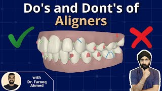 Do's and Dont's of Aligners - PDP071
