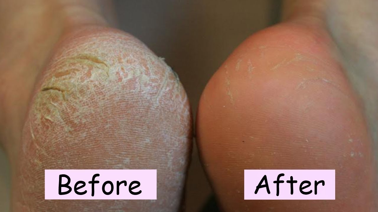 Get Rid of Calluses Overnight How to Treat a Callus How To Remove