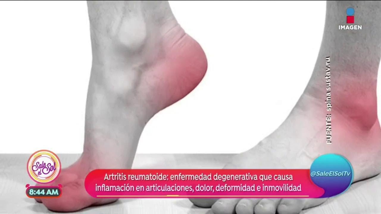 como curar el dolor de artritis reumatoide
