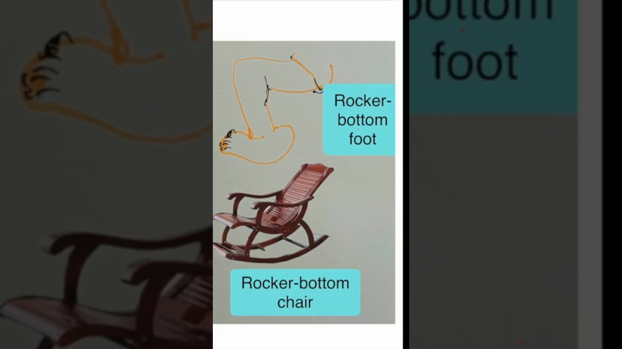 CVT (Congenital Vertical Talus) and oblique talus | Basic knowledge | Spot diagnosis